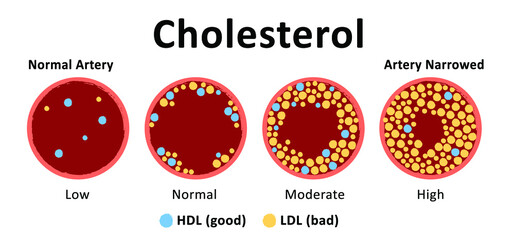 Cholesterol in artery, health risk. The accumulation of cholesterol in the blood vessels. Atherosclerosis of blood vessels. Cholesterol in the arteries. HDL or LDL . Vector medical blood flow sign.