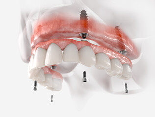 Maxillary prosthesis