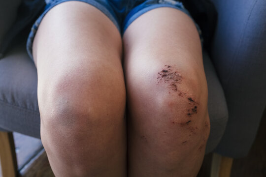Girls scabbed knee after an accident