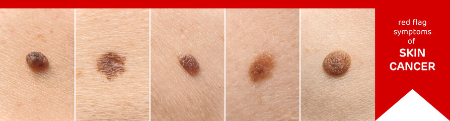 Different types of moles on human skin, closeup. Concept of skin cancer