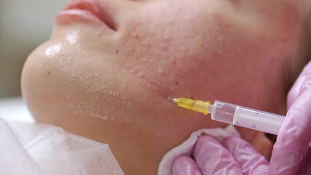 Cosmetologist makes the Rejuvenating facial injections procedure for tightening and smoothing wrinkles on the face skin of young woman in a beauty salon