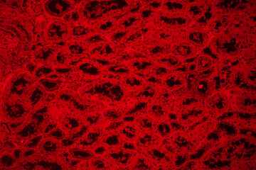 Compression atrophy of human kidney