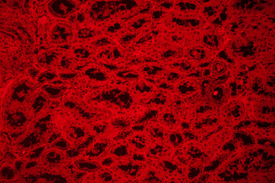 Compression atrophy of human kidney