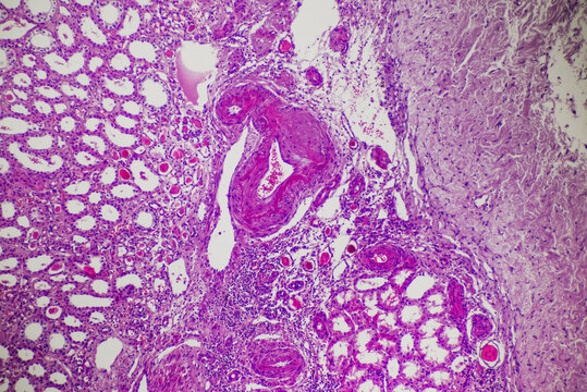 Compression atrophy of human kidney