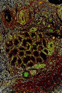 Compression atrophy of human kidney