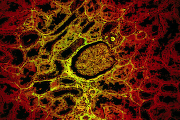 Compression atrophy of human kidney