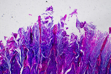 Leprosy skin of human skin