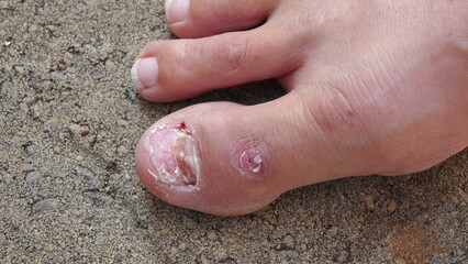 A new toenail is growing in on a man's big toe after removal of old, damaged one. 