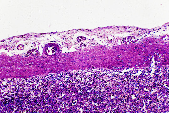 Central antery hyaline degene of human spleen