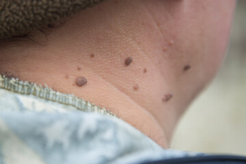 Papillomas on the human neck. Removal of papillomas.