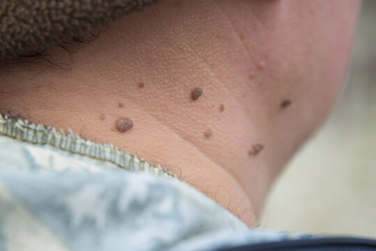 Papillomas on the human neck. Removal of papillomas.