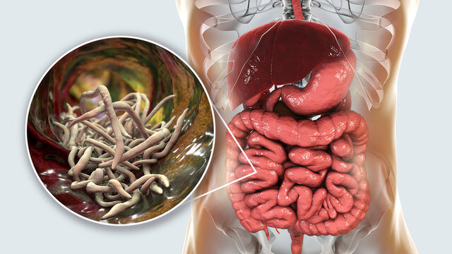 Parasitic worms in human intestine