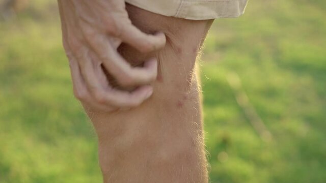 A man on a natural background scratches his legs that were heavily bitten by mosquitoes. Biting insects concept
