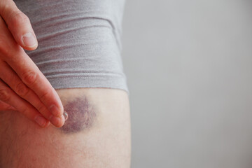 Man applies the healing gel to the bruise. Bruise on leg