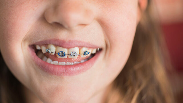 Close up of girl's (8-9) mouth with braces