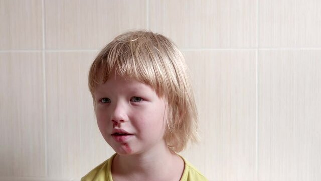 little fair-haired boy is smeared with blood. baby has weak vessels in nose bursting with pressure drops and changes in weather. Hemophilia disease