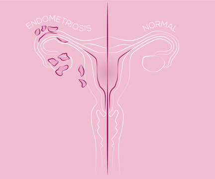 Illustration Of Endometriosis, Endometrial Tissue In The Uterus, Female Disease, Womens Medicine