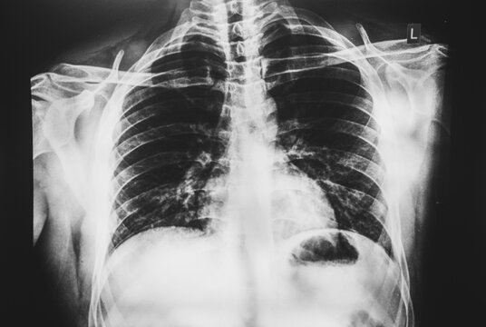 Chest/rib cage scan/x ray