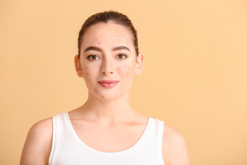 Young woman with acne problem on color background