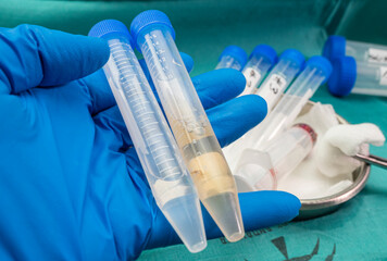 Vials with samples of cerebrospinal fluid in patients with transverse myelitis after being injected...
