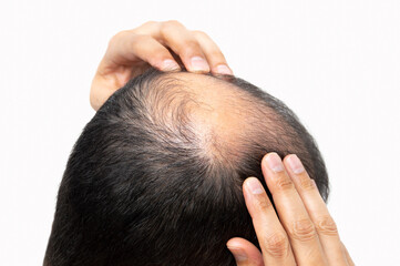 Middle-aged man concerned with hair loss. Baldness