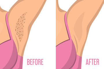 Armpit depilation before and after vector isolated. Female body, hair removal. Skin care, epilation procedure.