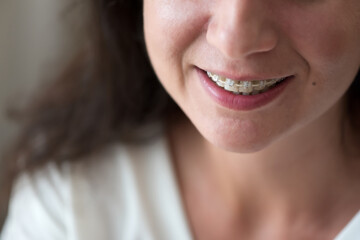 Close-up woman smile with braces. Orthodontics treatment. Body positive. Soft focus