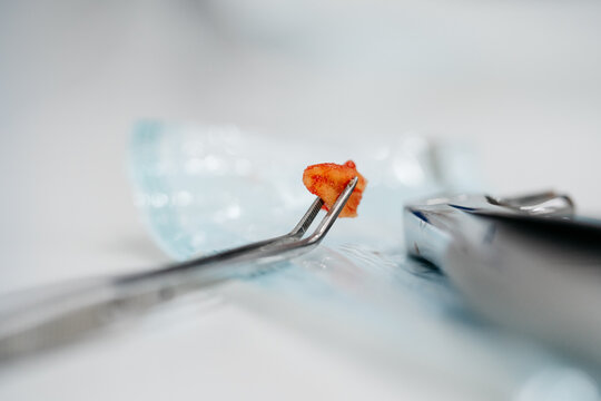 Detail of a dental extraction