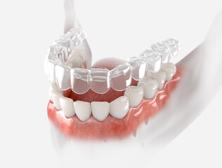 Transparent retainer fixed on lower jow.