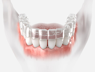 Transparent retainer fixed on lower jow.