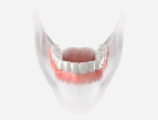 Transparent retainer fixed on lower jow.