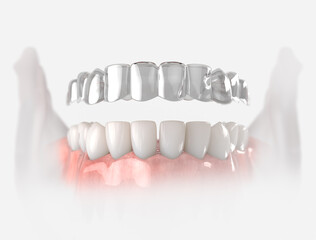 Transparent retainer fixed on lower jow.