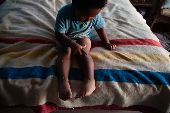 child puts lotion on bugbites