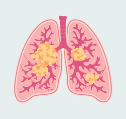 Lung cancer - vector patient-friendly scheme. Anatomical diagram in hand drawn style. Respiratory disease - Lung Carcinoma. Oncologic tumor and metastasis