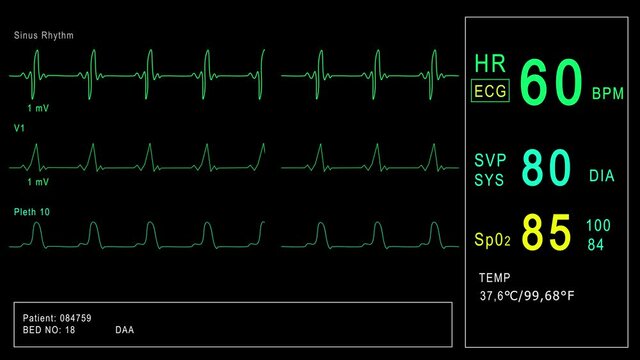 Looped: Patient monitor displays vital signs ECG electrocardiogram EKG, oxygen saturation SPO2 and respiration. Medical examination. 4K video footage animation. Cardiac monitoring. Electrocardiography