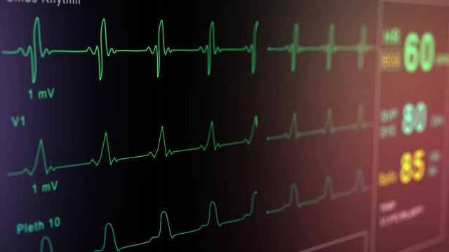 Patient monitor displays vital signs ECG electrocardiogram EKG, oxygen saturation SPO2 and respiration. Medical examination. 4K video footage animation. Cardiac monitoring. Electrocardiography