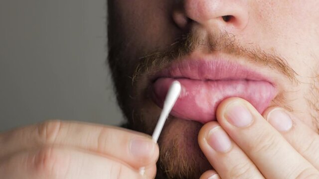 putting healing gel ointment on an aphtha oral inflammation on the gums with a cotton swab