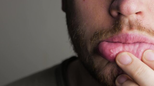 an aphtha oral inflammation on the gums