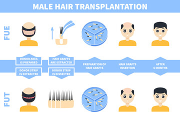 Male alopecia treatment with FUE and FUT methods. Follicular unit extraction versus follicular unit transplantation. Hair transplant stages. Medical infographics. Vector illustration.