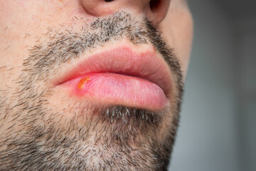 Close up of cold sore on lip. Herpes disease on man's face, infectious virus