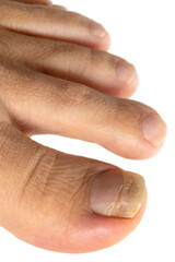 足の指の爪水虫