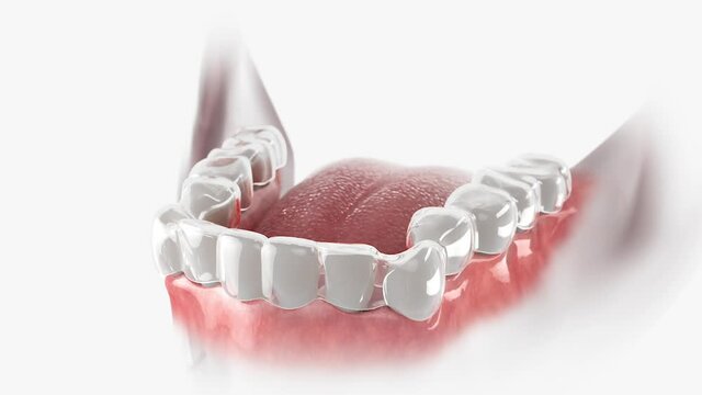 Teeth correction with transparent orthodontic retainer. 3D animation.