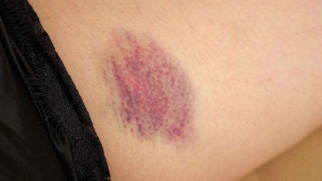 Close-up of blue and pink bruise on woman's thigh, camera close in