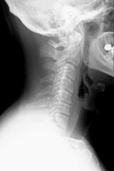 X-ray image of cervical, lateral view