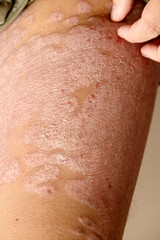 Fototapeta premium Diseases caused by abnormalities of the lymph. Psoriasis is a skin disease.