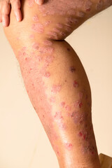 Fototapeta premium Diseases caused by abnormalities of the lymph. Psoriasis is a skin disease.