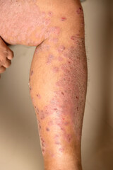 Diseases caused by abnormalities of the lymph. Psoriasis is a skin disease.