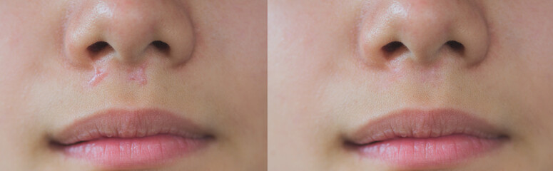 image compare keloid scars on skin face before and after laser treatments - obrazy, fototapety, plakaty