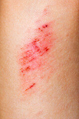 Fototapeta premium Wounds on the skin. Deep scratches on the skin. Wounds, scratches and abrasions on skin