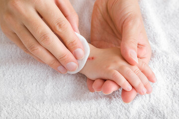 Young woman hand using white cotton pad and cleaning abrasion on baby hand skin after accident. Mother giving first aid. Closeup.